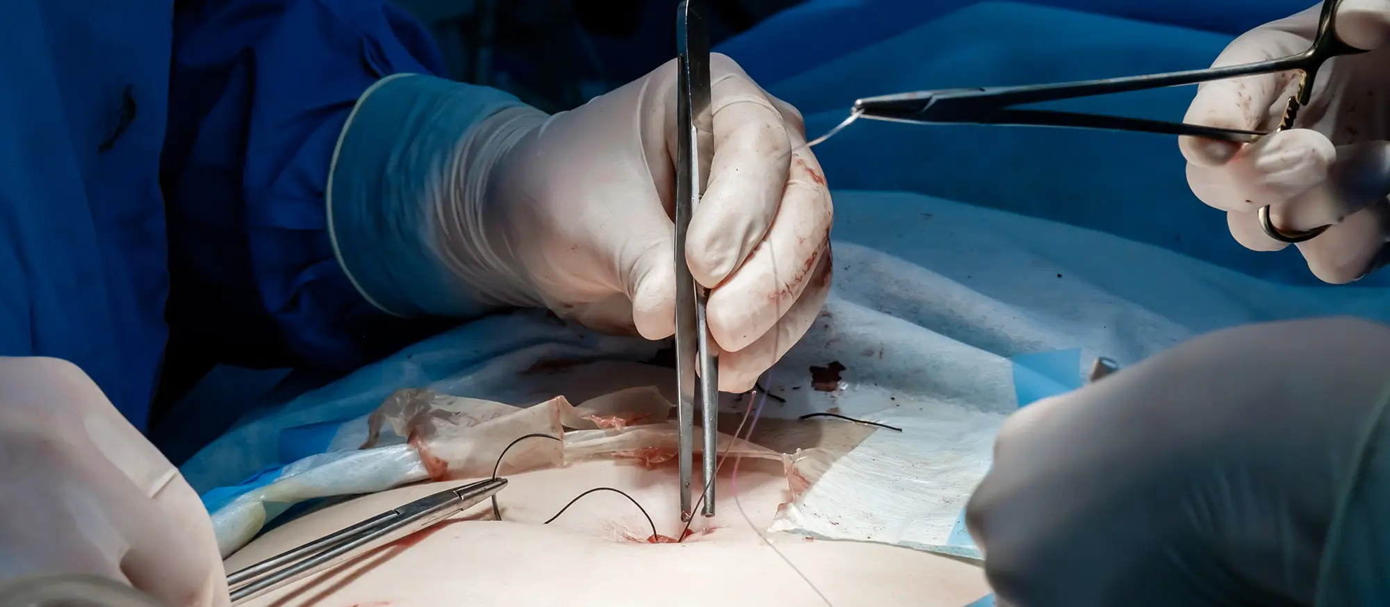 Dermatologische Operation